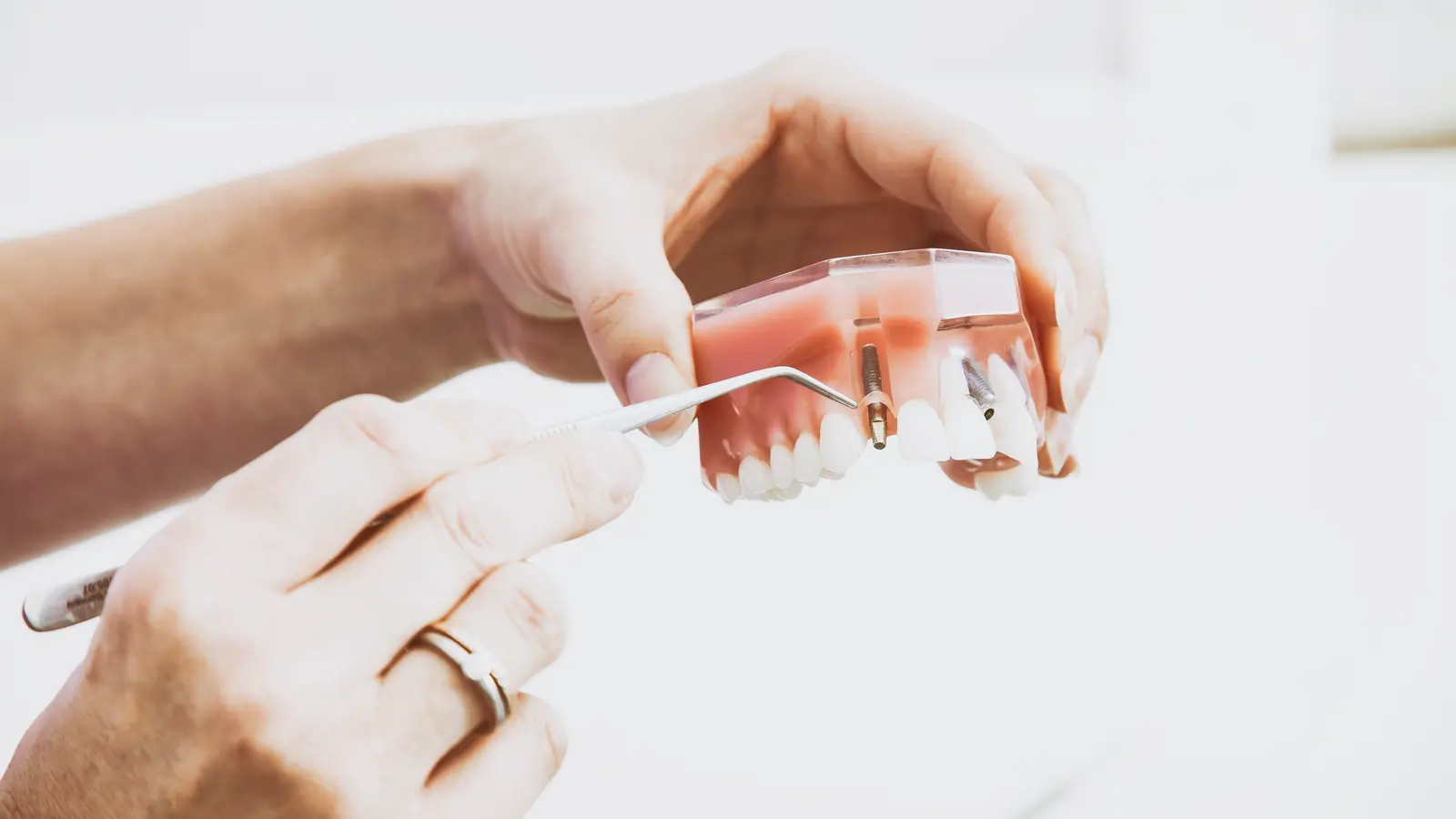Hands holding a model of a lower jaw with a fitted dental appliance