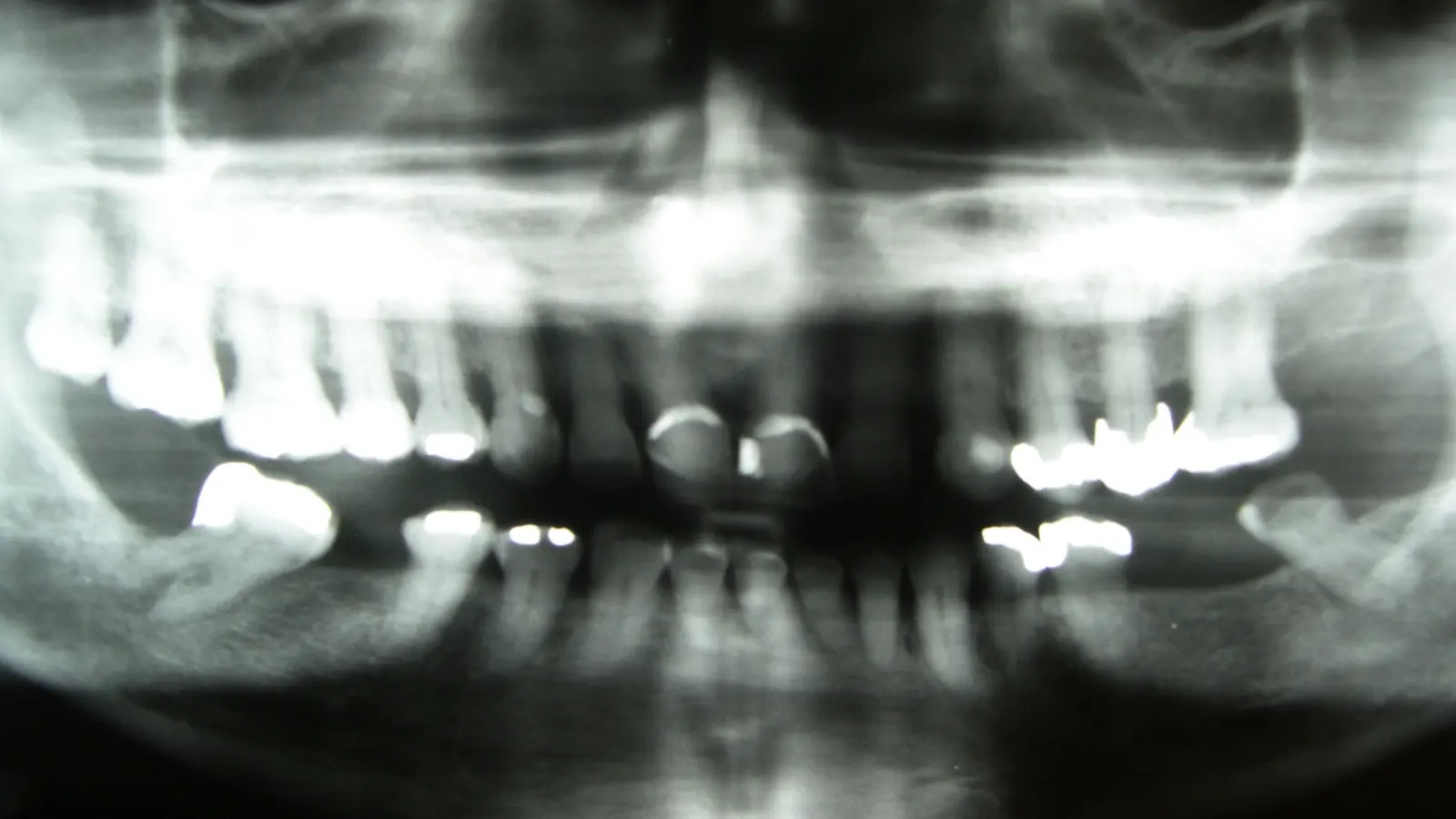 A panoramic dental radiograph showing a full set of upper and lower teeth